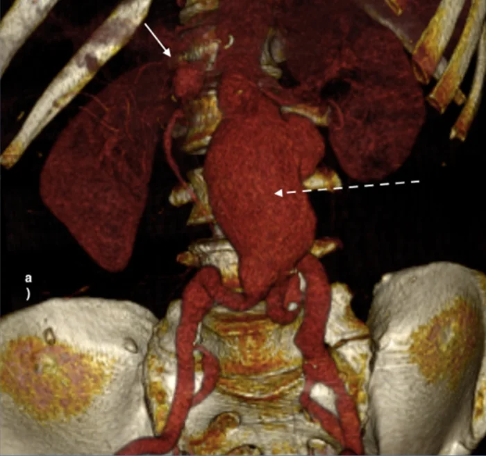 Imagen Aorta Abdominal