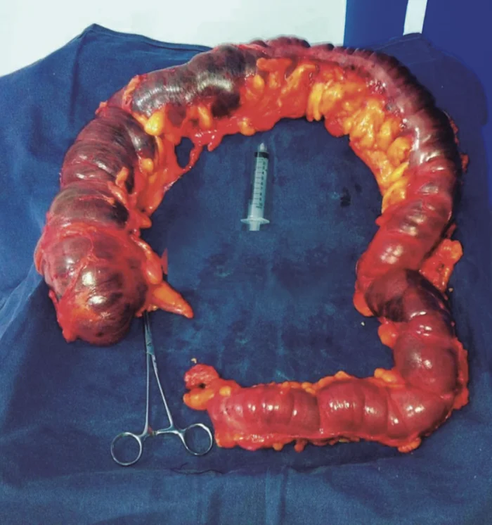 Imagen Colectomía Total de Megacolon Tóxico
