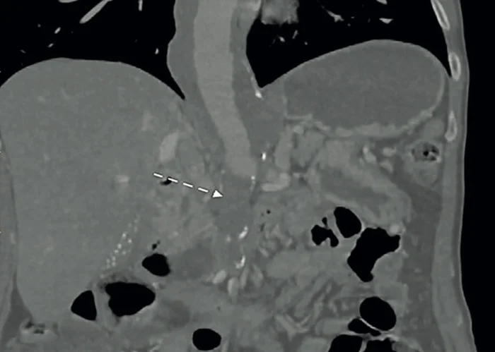 Imagen tomografía de Abdomen con Angiograma